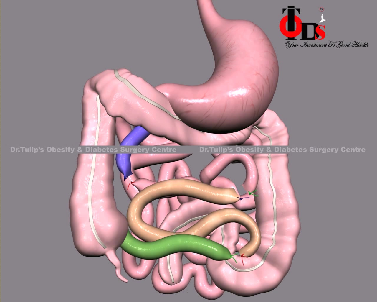 Ileal Interposition Surgery